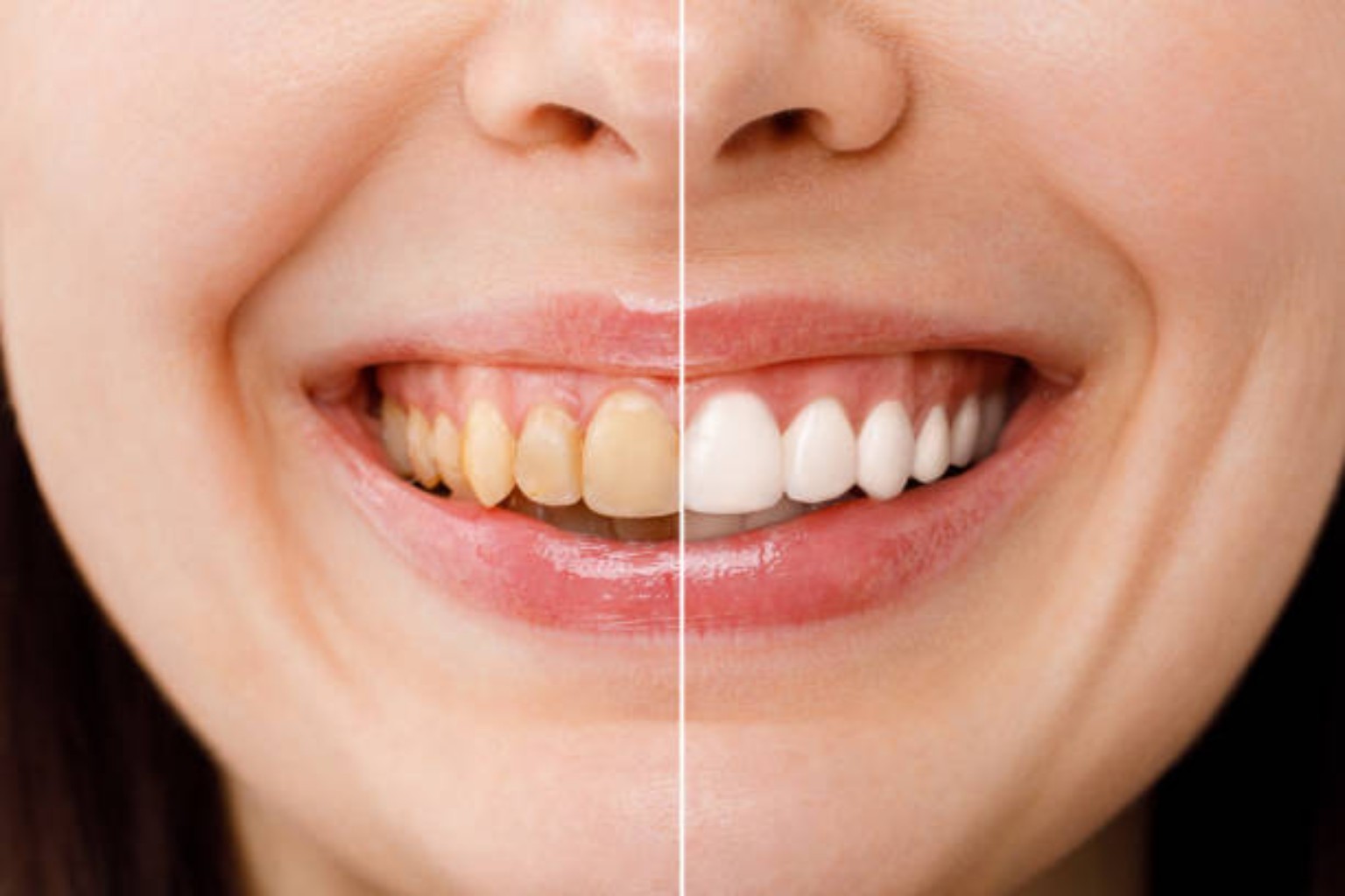 Teeth Whitening guides
