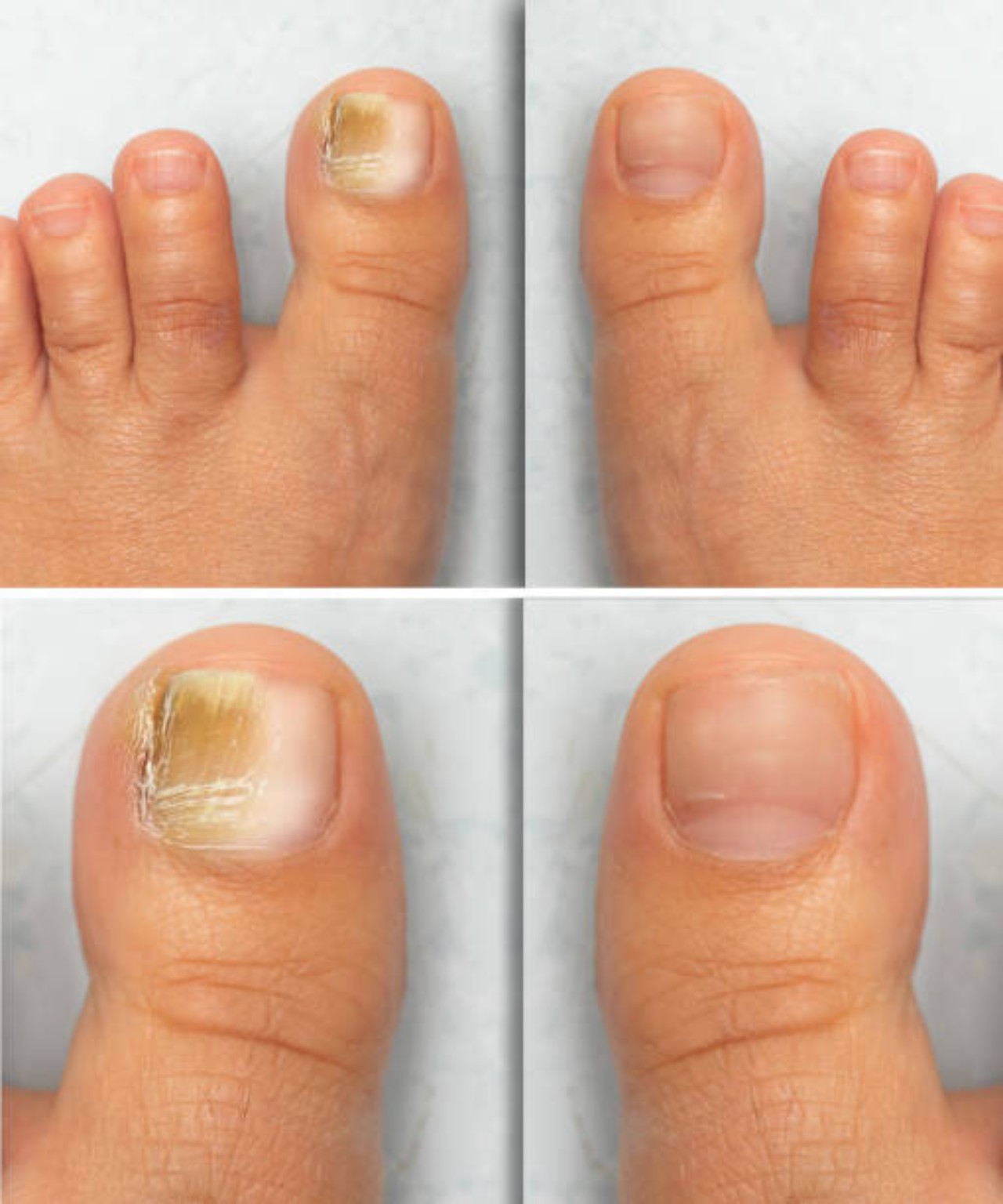 Fungal Nails